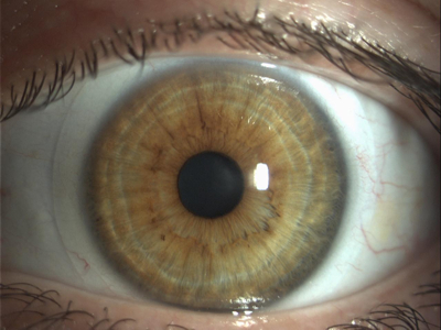 weiche Linse auf Auge Augenoptiker